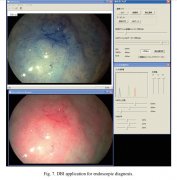 电子染色DBI-早期癌