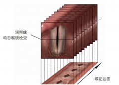 喉记波扫描VSK